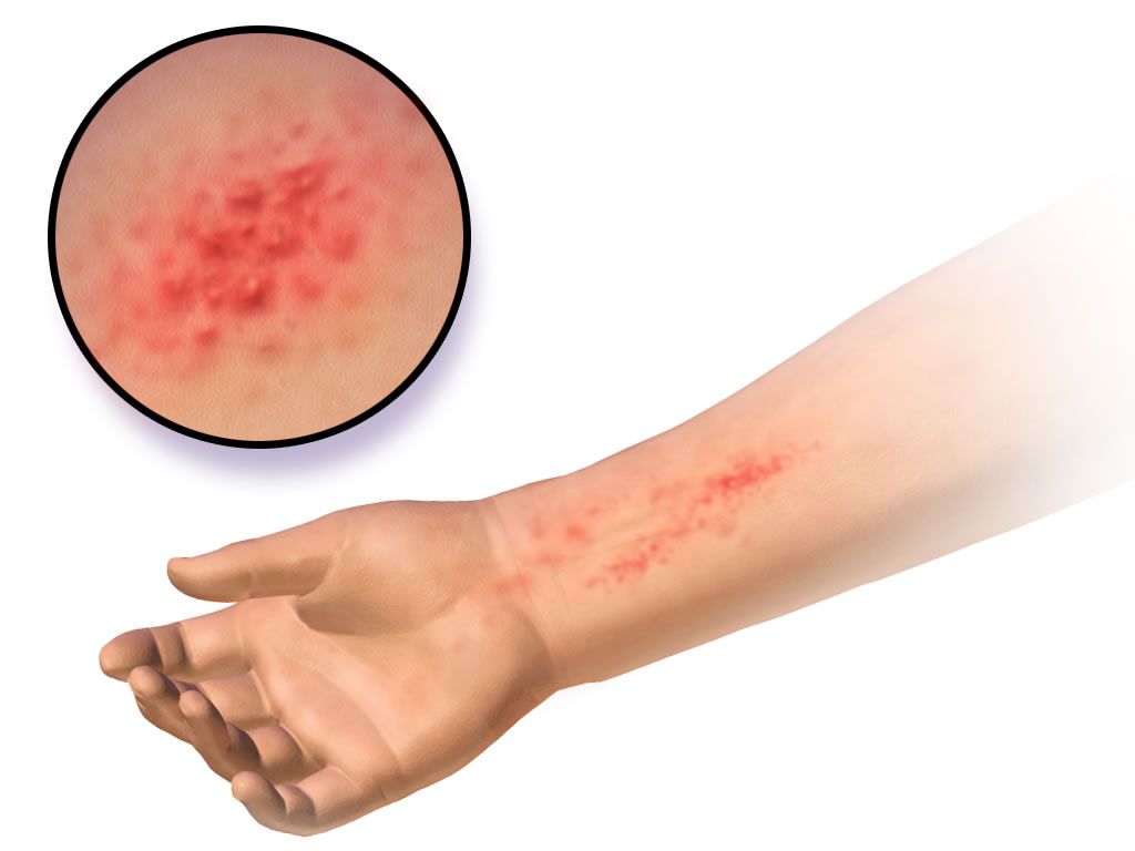 Симптомы, признаки и лечение аллергии | Поликлиника Медицинский Комплекс | Липецк